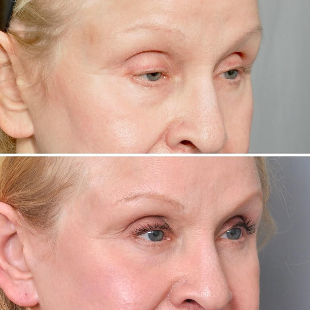 Before and after photos of a person's eyes showing a reduction in eyelid sagging.