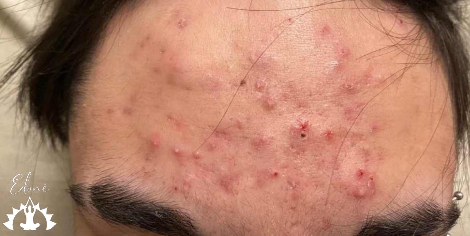 Cura dell' acne