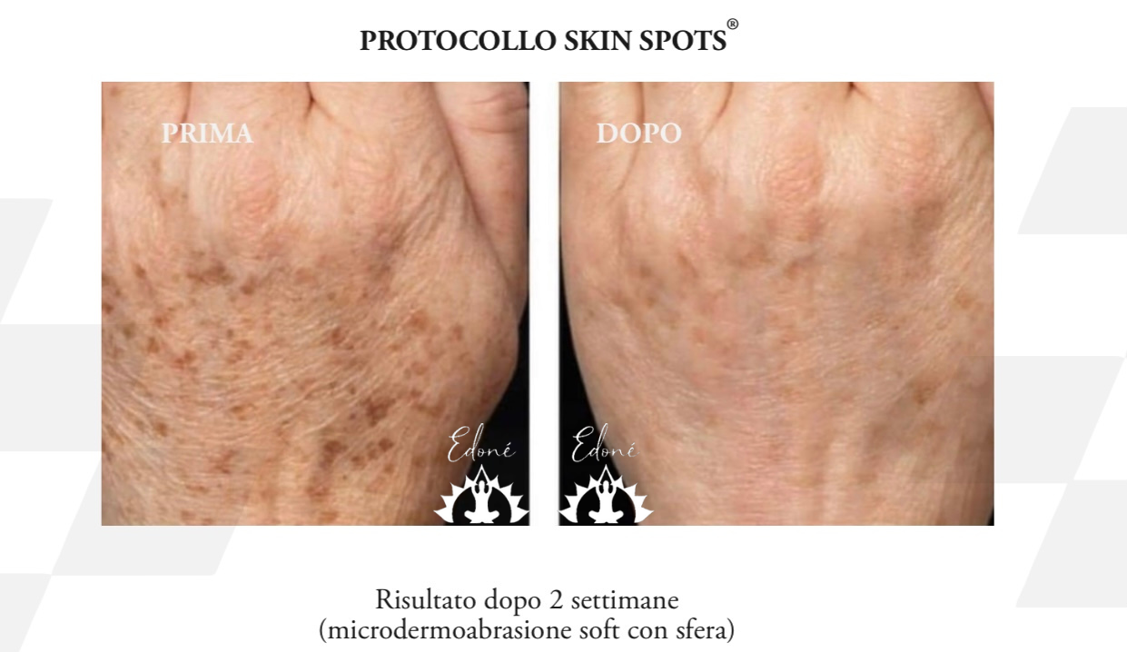 Skin Spots