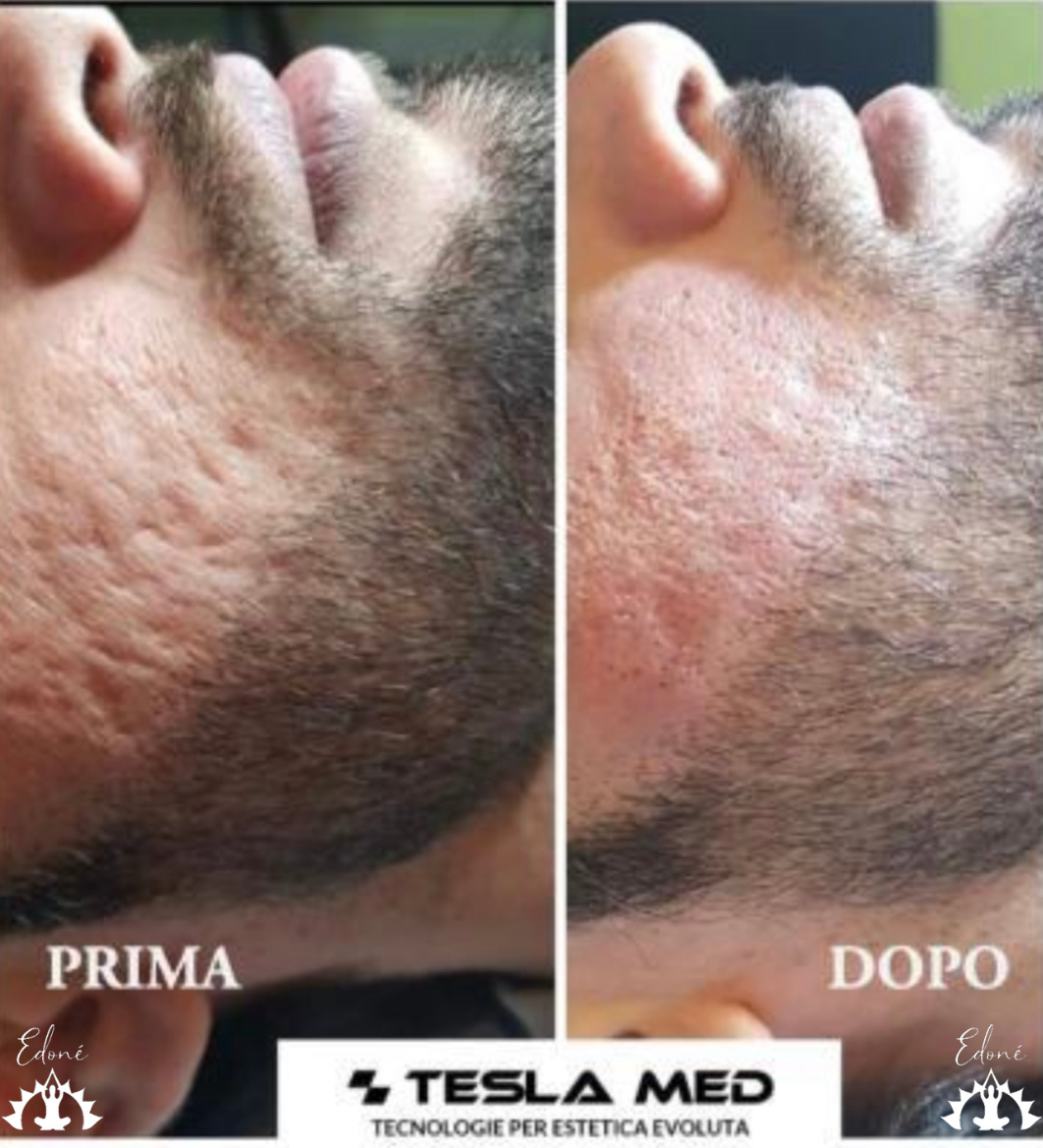 Rimozione cicatrici acne