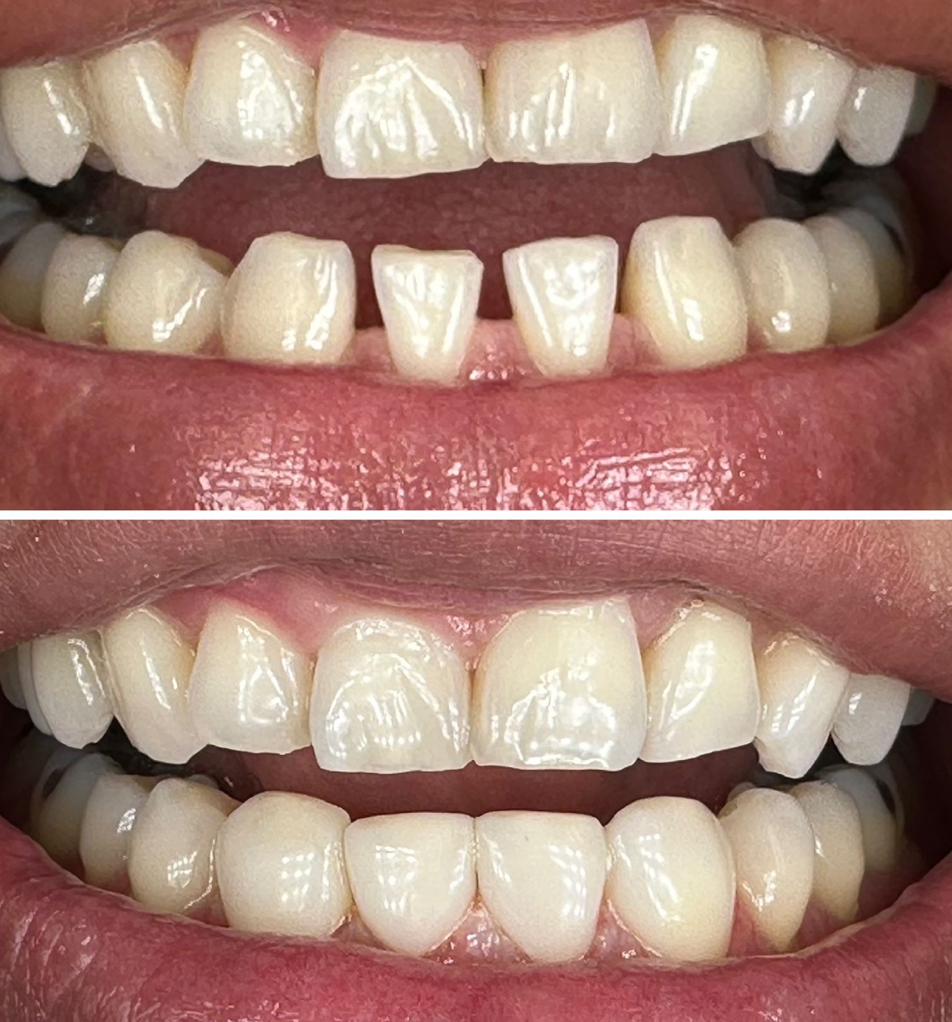 Top and bottom teeth before and after cosmetic dental work to close gaps.