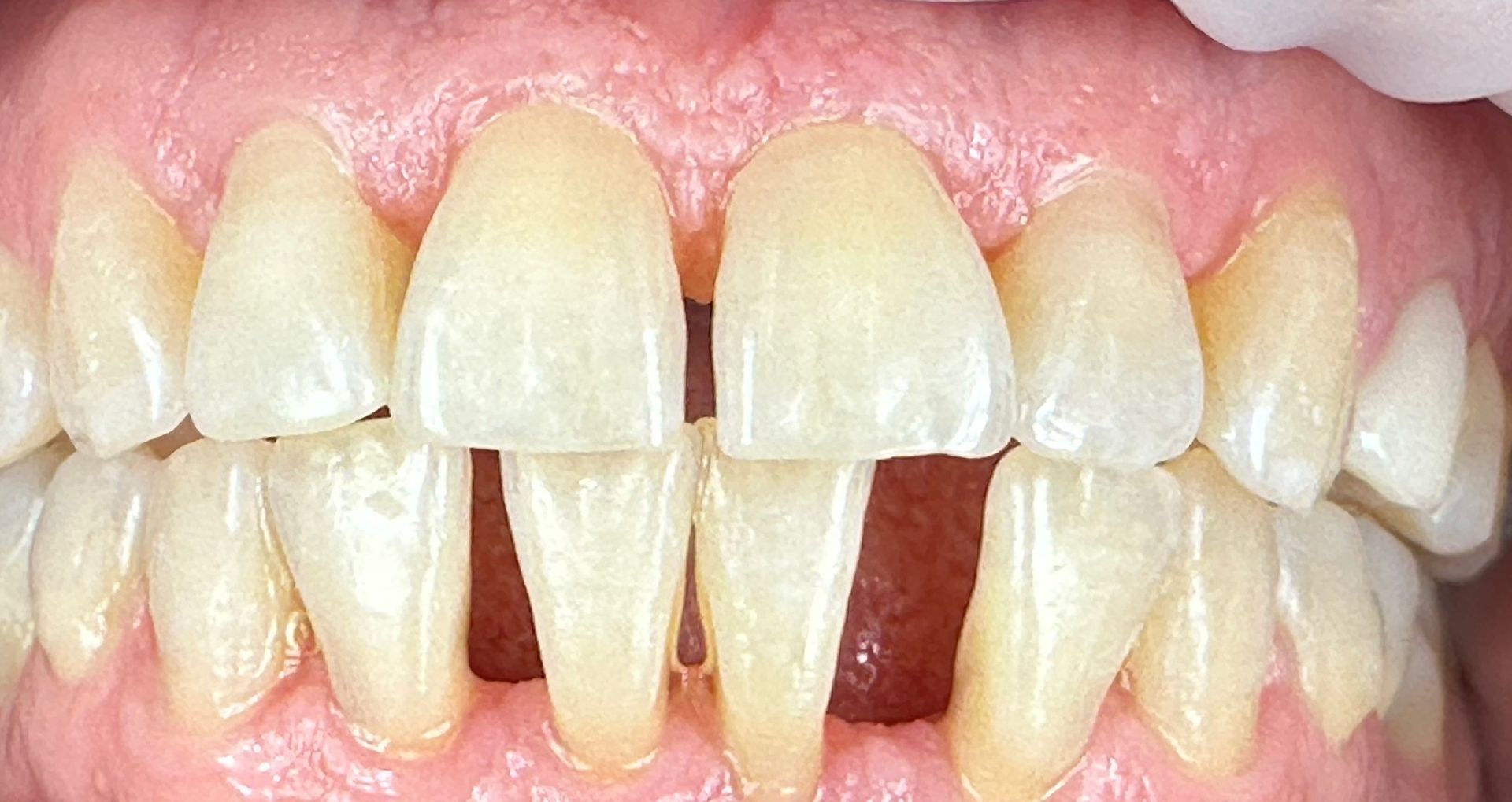 Close-up of a person's teeth showing a gap between the front teeth, and a pink gum line.