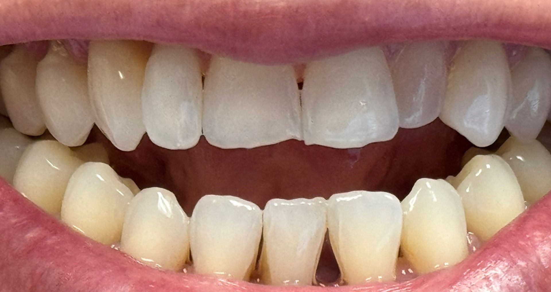 Close-up of teeth showing a gap between the top front teeth.