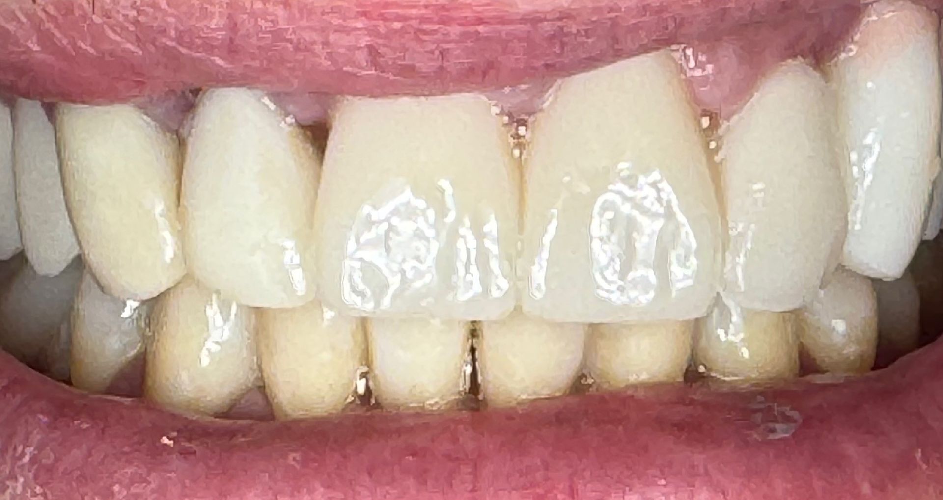 Close-up of teeth showing uneven wear and slight misalignment; mostly white with pink gums.