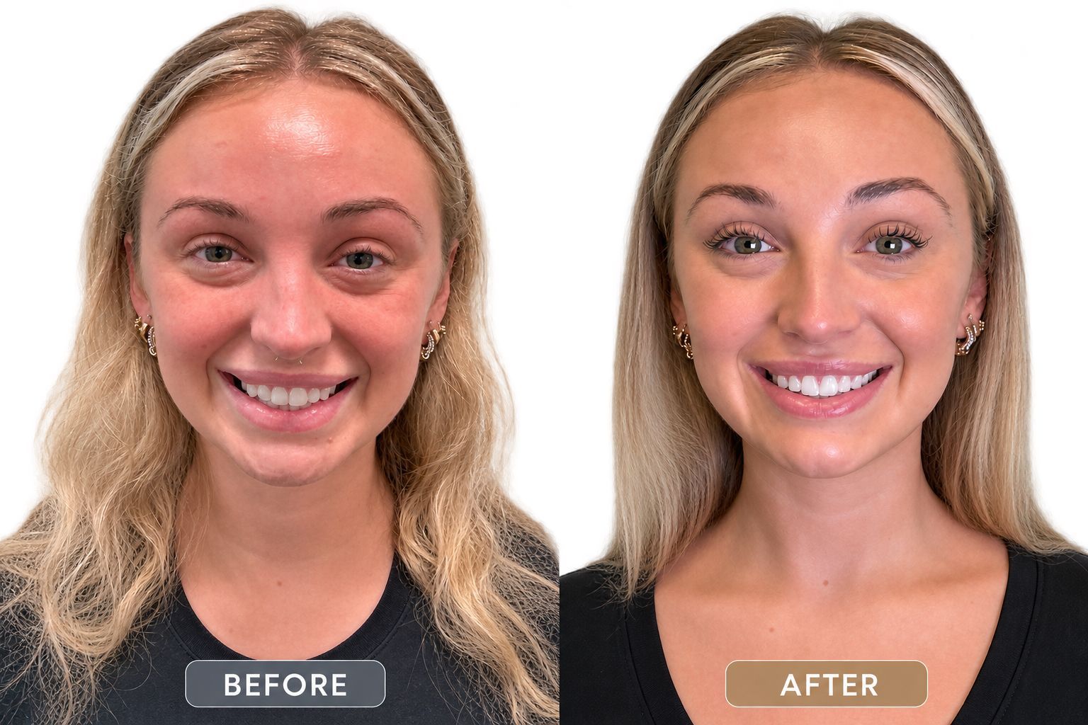 Facial balancing with dermal filler before and after at Longevity 360 Med Spa in Newark, Delaware