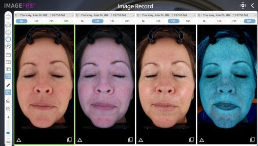 3D face scan results and skin analysis at Longevity 360 Med Spa
