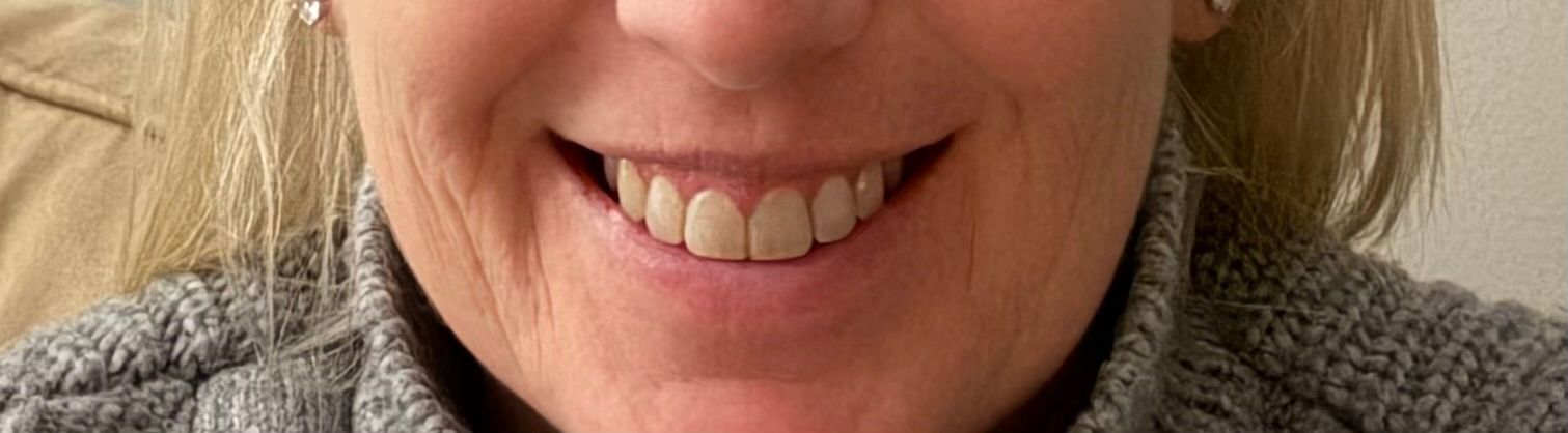 Botox lip and smile line treatment after treatment at Longevity 360 Med Spa