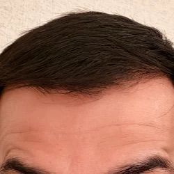 Botox forehead line treatment after treatment at Longevity 360 Med Spa