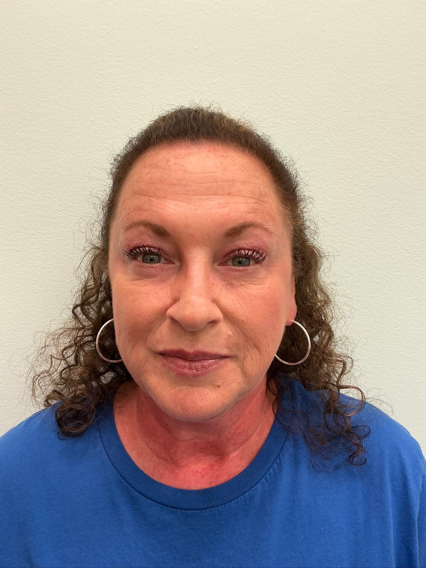 Dysport forehead line treatment after treatment at Longevity 360 Med Spa