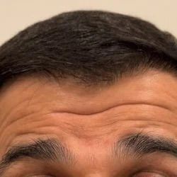 Botox forehead line treatment before treatment at Longevity 360 Med Spa