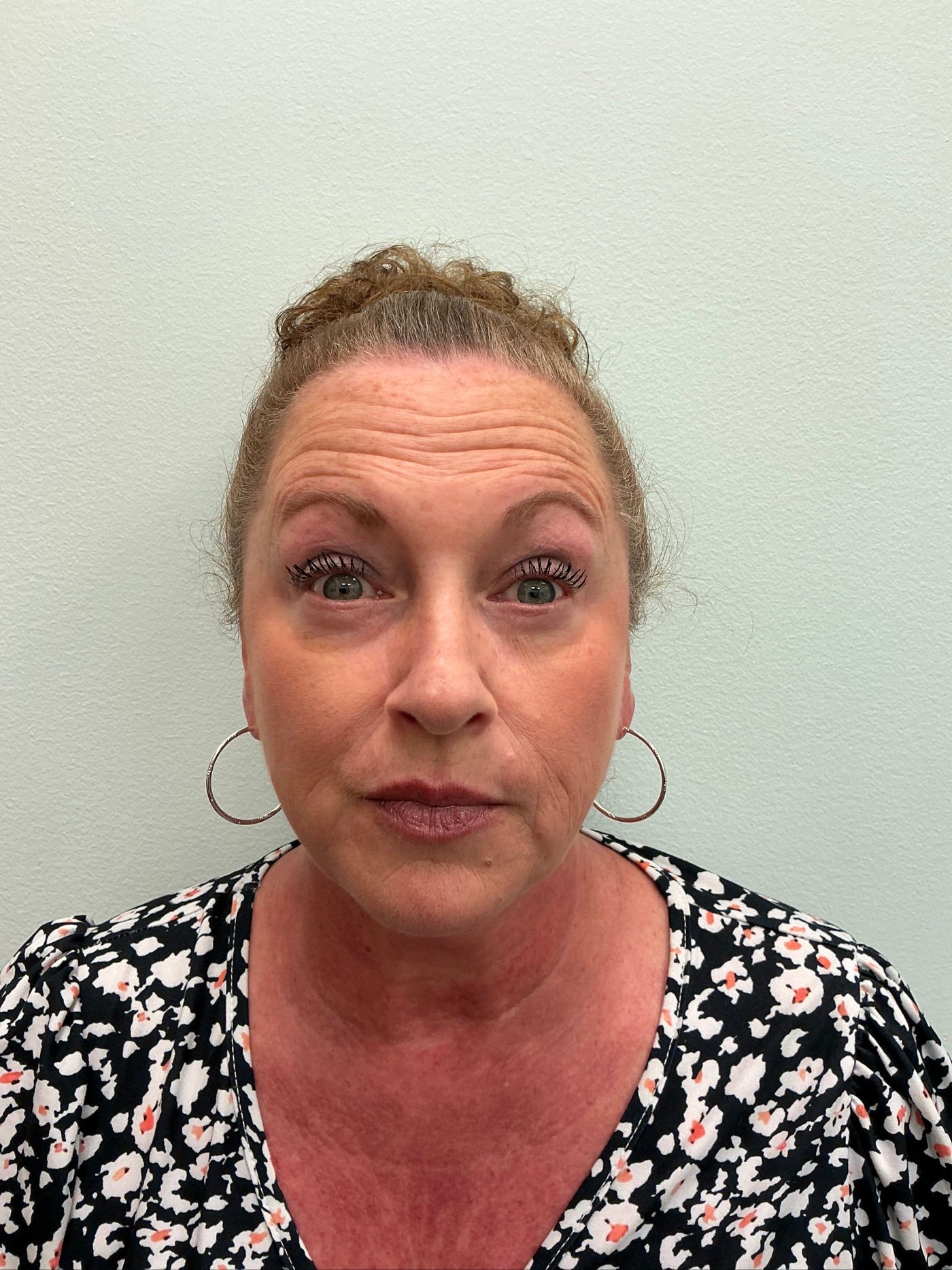 Dysport forehead line treatment before treatment at Longevity 360 Med Spa