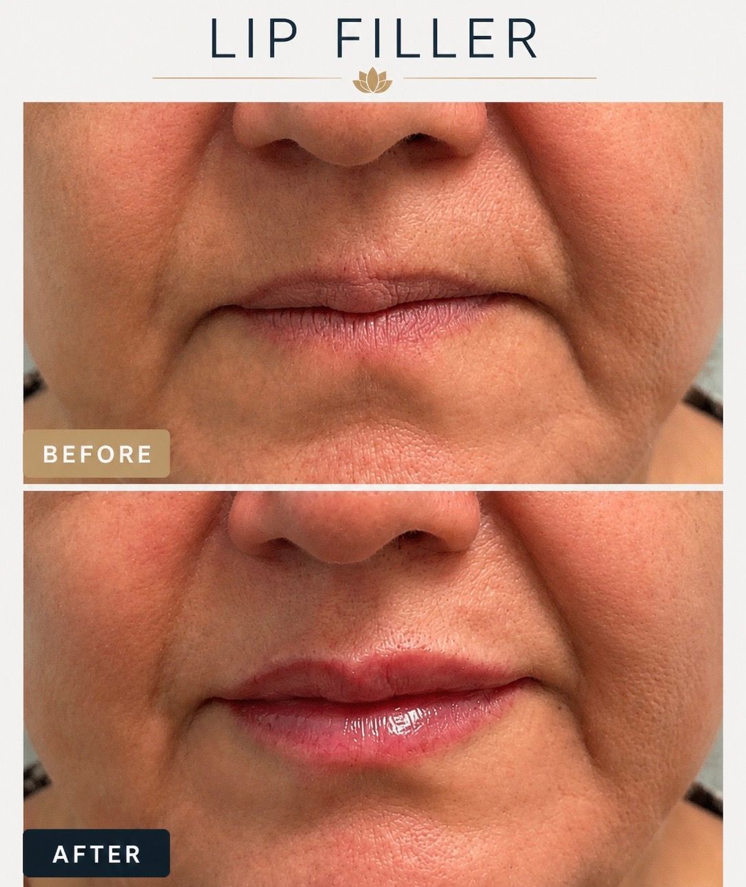 Lip filler before and after at Longevity 360 Med Spa in Newark, Delaware