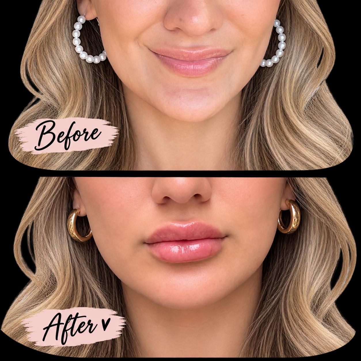 Lip filler before and after result at Longevity 360 Med Spa in Newark, Delaware