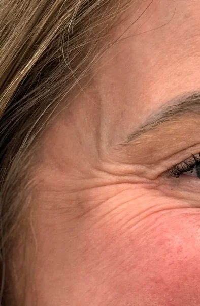 Botox crow’s feet treatment before treatment at Longevity 360 Med Spa