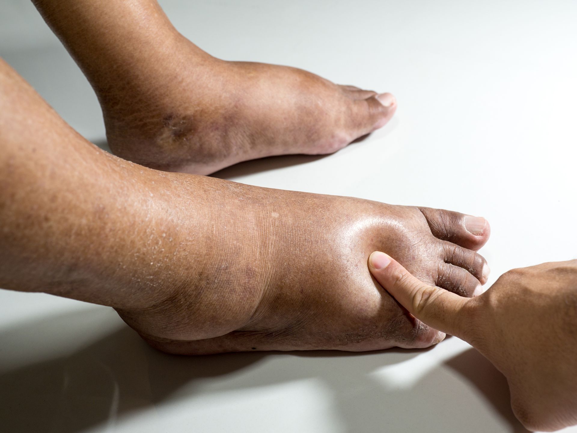 Close-up of swollen foot being examined