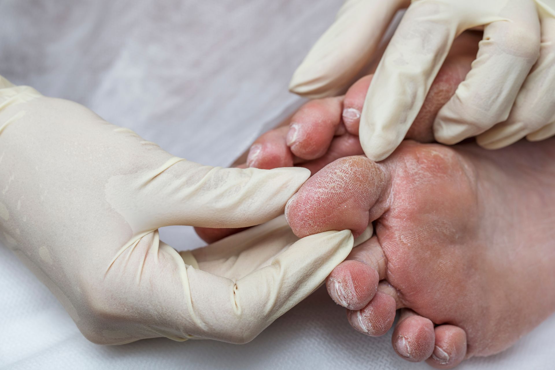 Medical professional examining foot ulcer with gloves