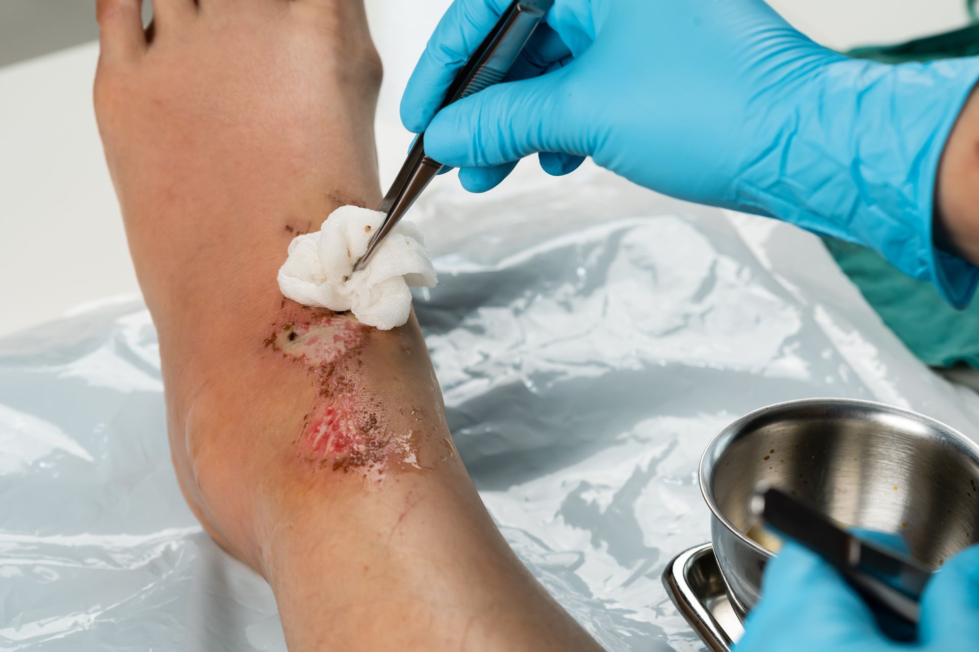 Medical professional cleaning wound on foot