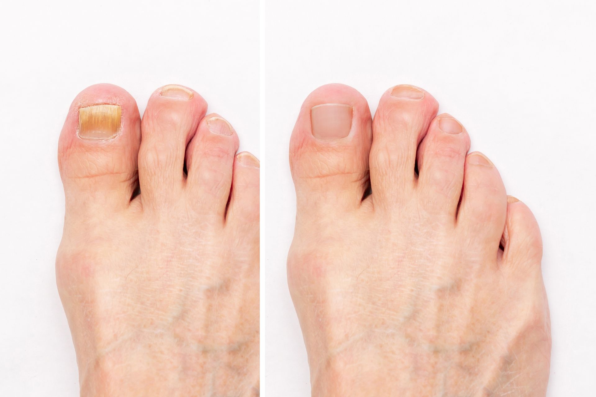 Close-up of toenails with fungal infection