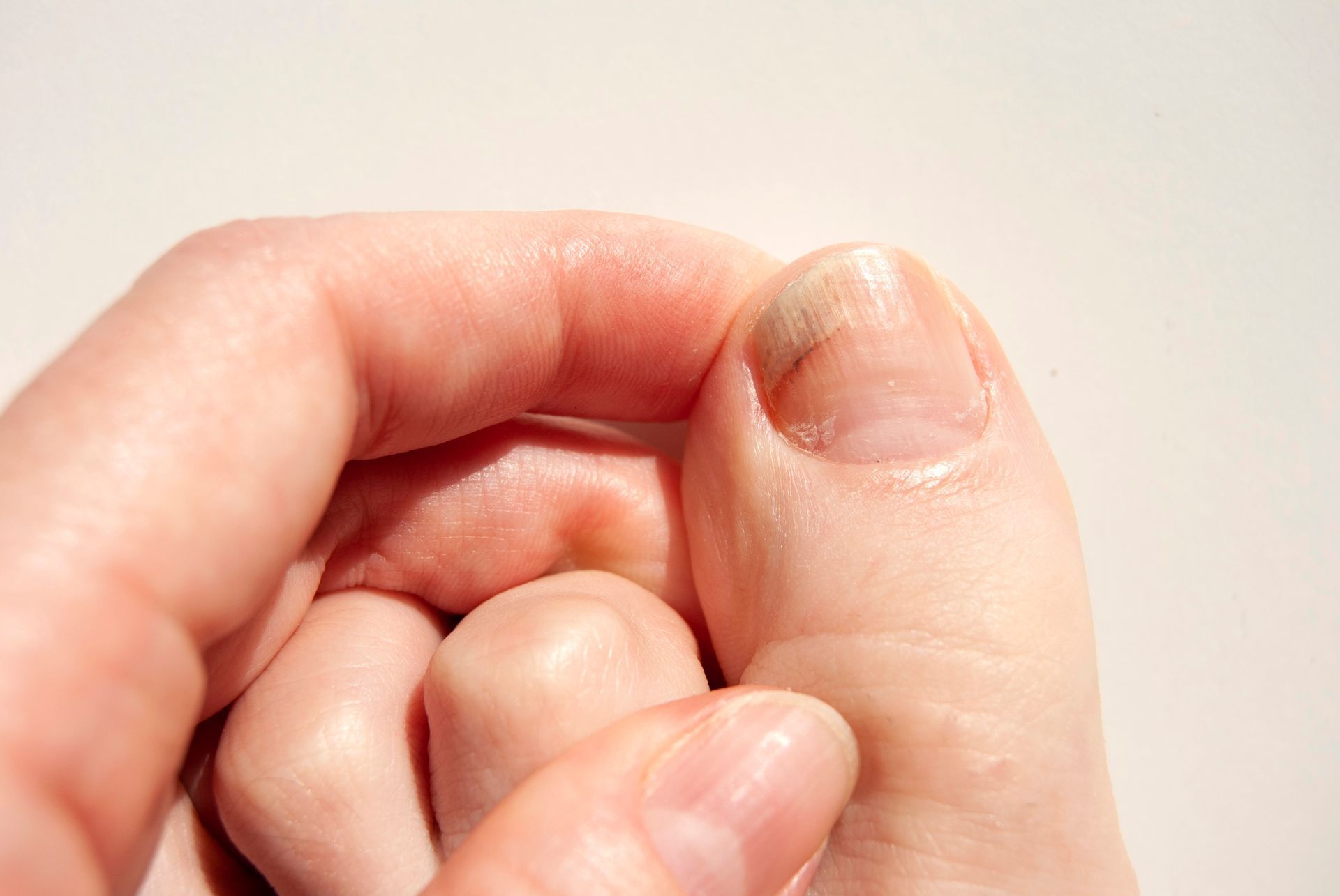 Close-up of big toenail being examined