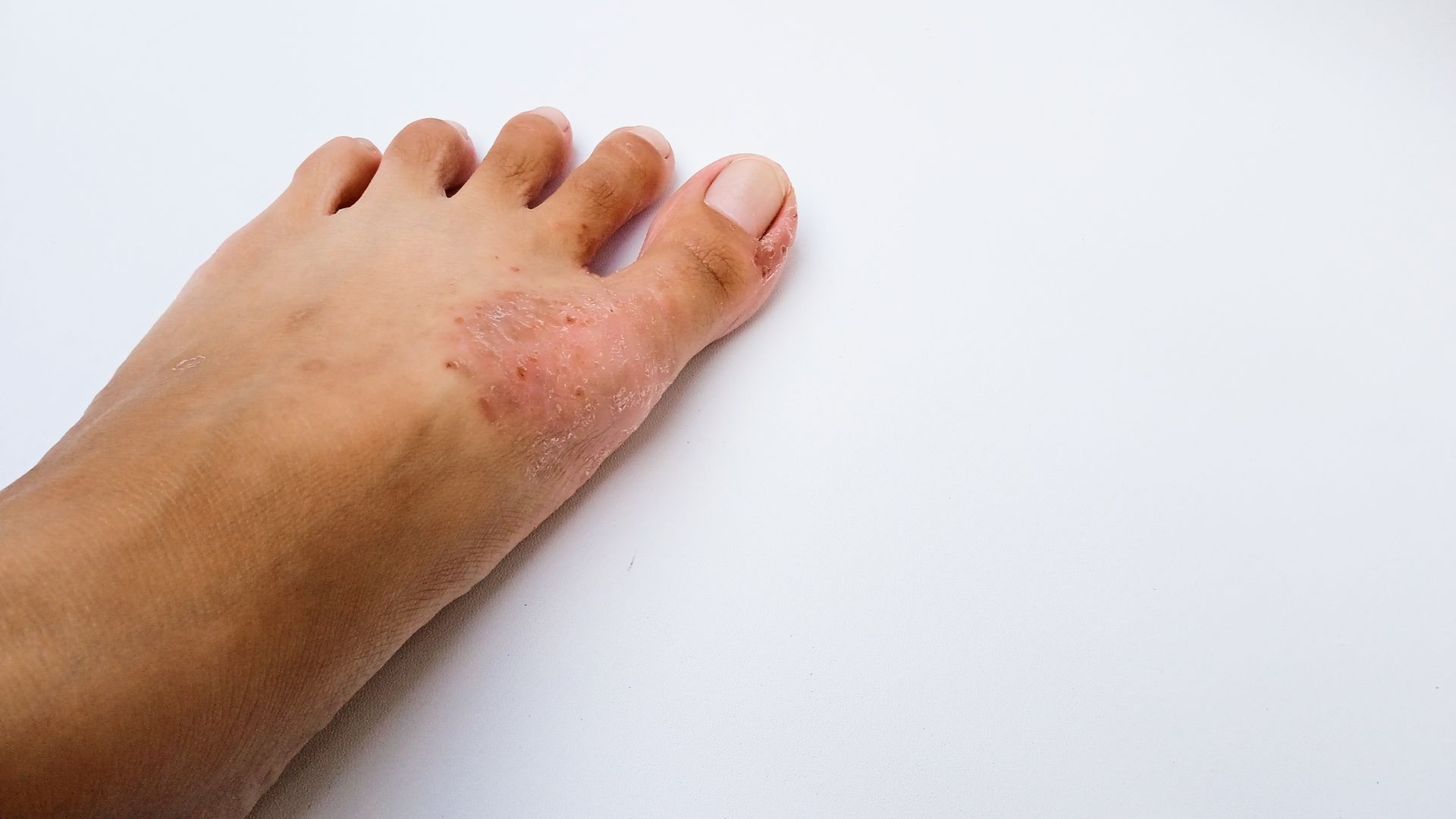 Top of foot with visible skin irritation and redness