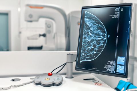 Uno schermo medico che mostra una mammografia accanto a un mammografo in una sala visite pulita e bianca.