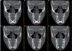 Una serie di sei immagini di tomografia computerizzata (TC) coronale che mostrano la cavità nasale e le strutture dentali in scala di grigi.