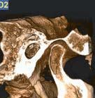 Tomografia computerizzata 3D che mostra un primo piano, di profilo laterale, di un'articolazione temporomandibolare (ATM) con degenerazione ossea e alterazioni strutturali.