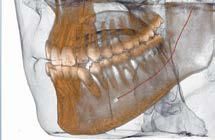 Una TAC dentale 3D che mostra una mandibola con denti, filo ortodontico e una sonda in prossimità delle radici dei premolari.