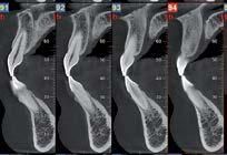 Una serie di quattro scansioni CBCT dentali sequenziali che mostrano l'allineamento degli incisivi superiori e inferiori.