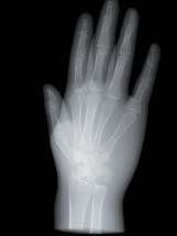 Radiografia di una mano umana che mostra le ossa delle dita, del palmo e del polso su sfondo nero.