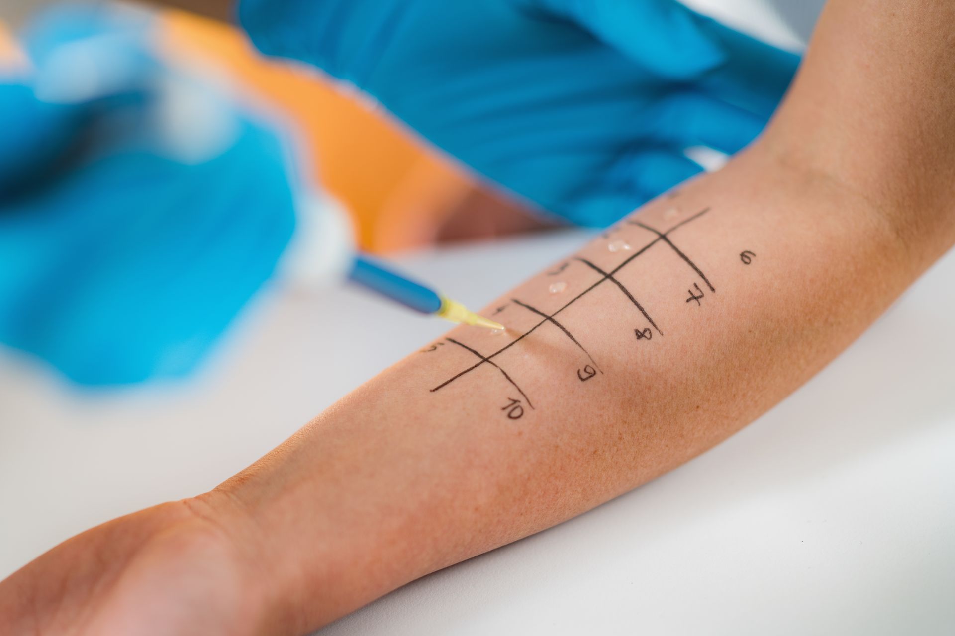 Healthcare worker performing an allergy skin test on a patient’s forearm with marked grid.