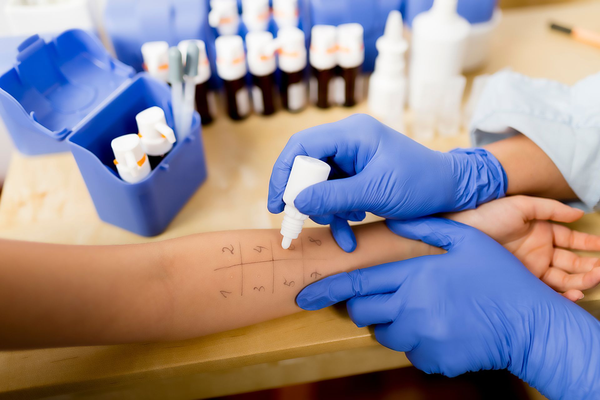 Gloved clinician applying skin prick allergy test drops.