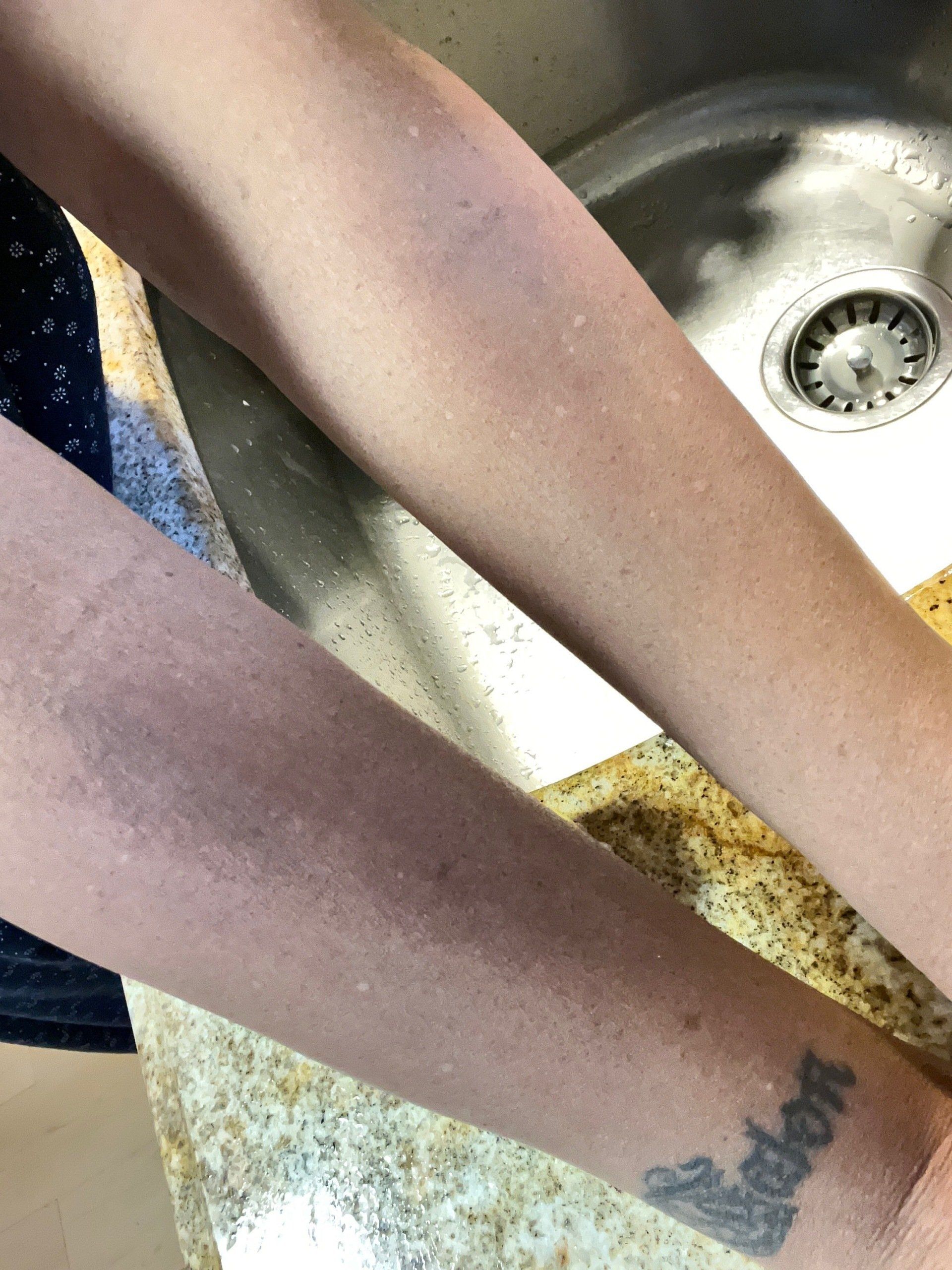 comparison of 2 arms: 1 scrubbed with Turmeric soap and the other not.