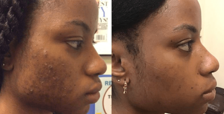 Before and after acne breakout and scarring on Melanin rich skin.
