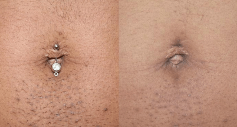 Before and after
