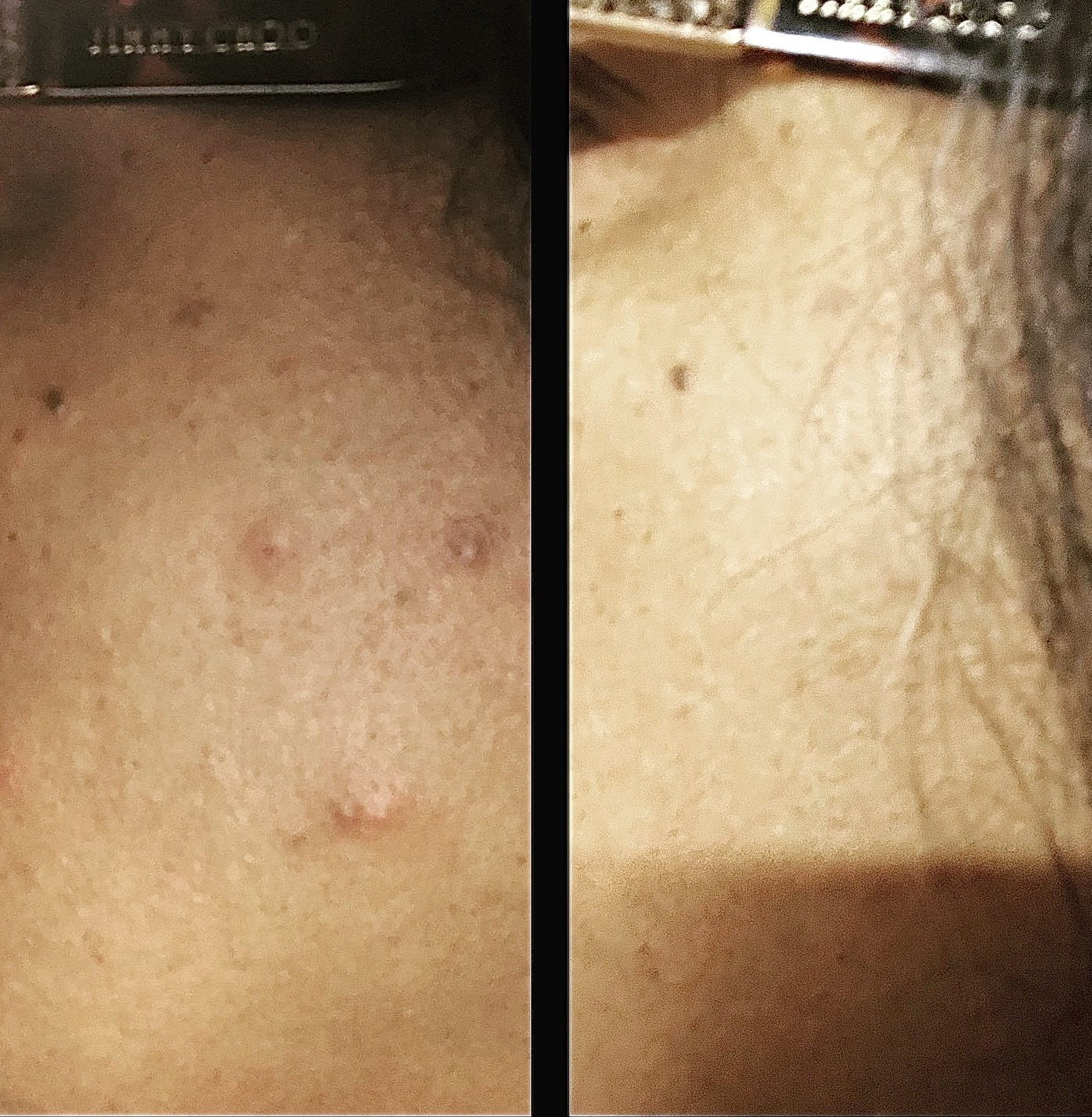 Hormonal acne before and after using elegance serum