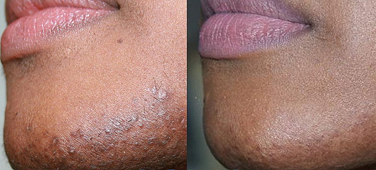 Acne and acne scarring before and after Elegance Serum