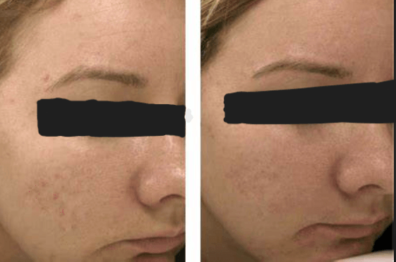 Before and after