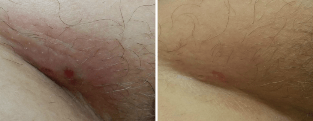 Before and After
