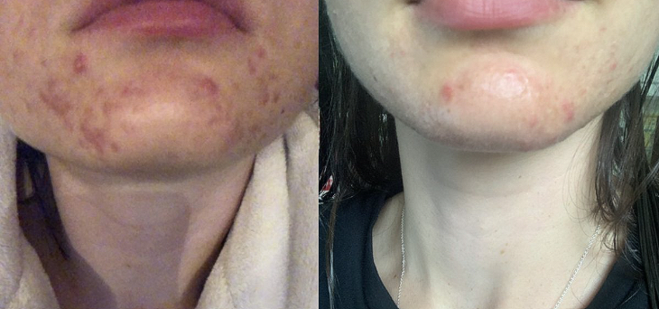 chin acne before and after Elegance Serum