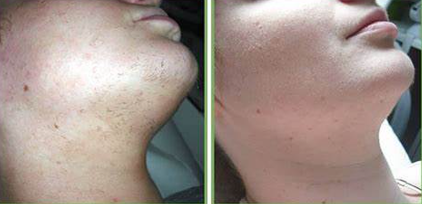 Before and after