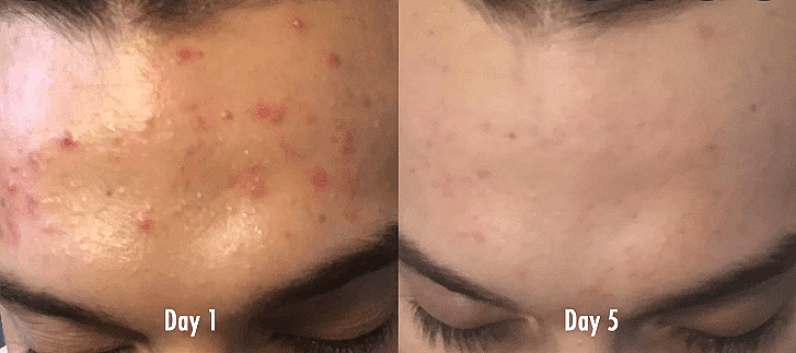 side by side image of forehead on left with acne breakout and forehead on right after using elegance serum.