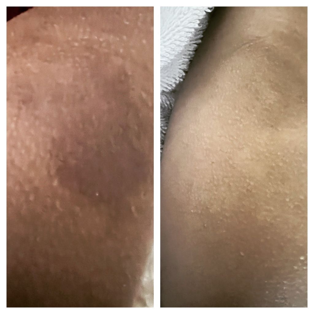 eczema on child's thigh before and after using elegance serum