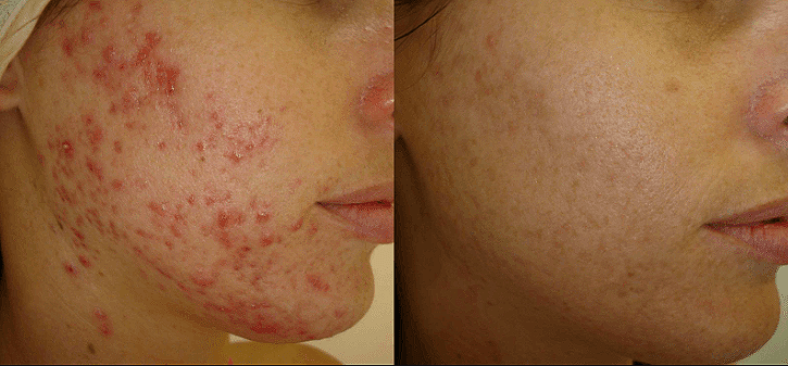 inflamed acne breakout before and after Elegance Serum