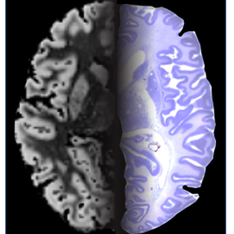 Aspen Neuroscience receives FDA RMAT designation for Parkinson’s candidate