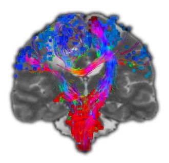 New brain-mapping tool may improve DBS surgery for Parkinson’s