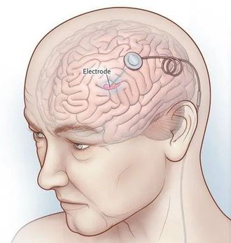 Early trial supports brain delivery of Parkinson’s therapy