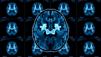Tavapadon shows promise across Parkinson’s disease stages