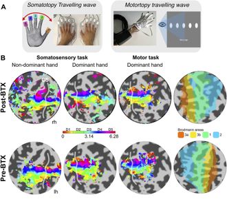 Early trial supports brain delivery of Parkinson’s therapy