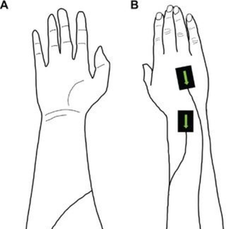 Study reveals new insights into essential tremor motor control